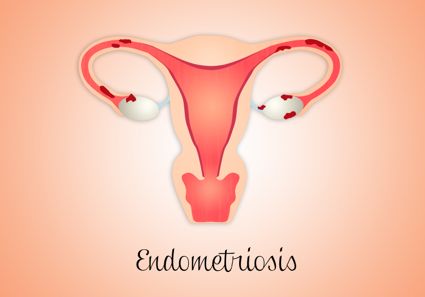 Endometriosis: an OB-GYN’s Perspective